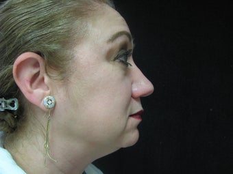 Face, 56 Year Old Female 1117318