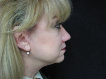 Face, 56 Year Old Female 1117318
