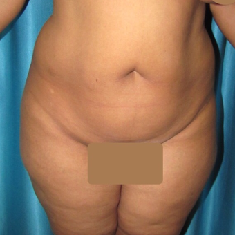 35-44 year old woman treated with Tummy Tuck before 3221773