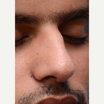Non Surgical Rhinoplasty before 2725428