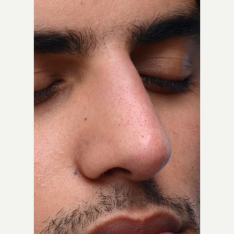 Non Surgical Rhinoplasty after 2725428