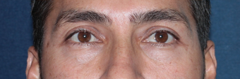 Before & After Restylane Injections after 966205