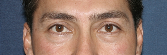 Before & After Restylane Injections before 966205