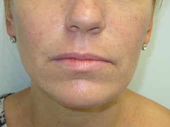 Lip Augmentation before 590715