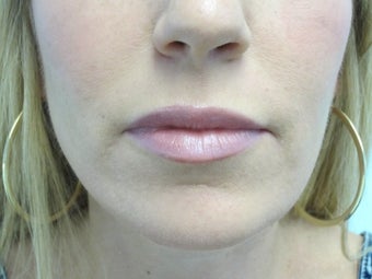 Lip Augmentation after 590715