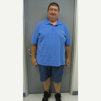 55-64 year old man treated with Sleeve Gastrectomy after 1909525