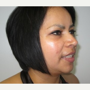 Chin Liposuction after 3141675