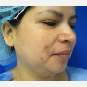 Chin Liposuction before 3141675