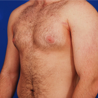 25-34 year old man with Gynecomastia treated with Male Breast Reduction before 3059447