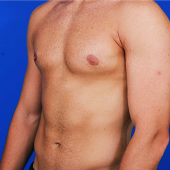 25-34 year old man with Gynecomastia treated with Male Breast Reduction after 3059447