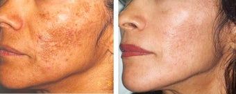 Female treated for excessive brown spots before 1010754