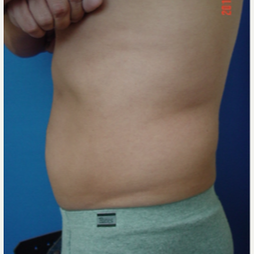 Liposuction Mid-section before 3103663