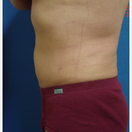 Liposuction Mid-section after 3103663
