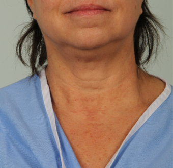 56 year old woman treated with Infini RF before 3162981