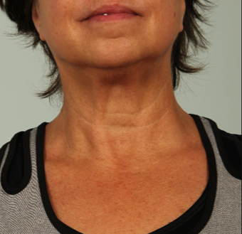 56 year old woman treated with Infini RF after 3162981