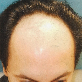 25-34 year old man treated with Hair Transplant before 3495001