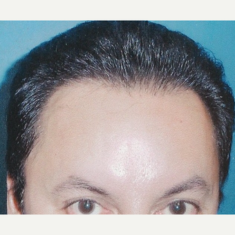 25-34 year old man treated with Hair Transplant after 3495001