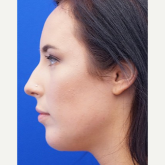 25-34 year old woman treated with Chin Implant after 3719111