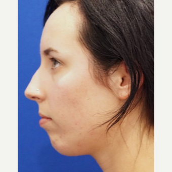 25-34 year old woman treated with Chin Implant before 3719111