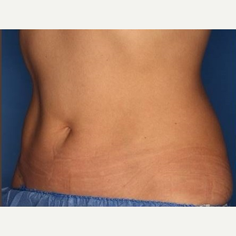 25-34 year old woman treated with CoolSculpting after 3711303