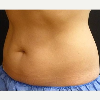 25-34 year old woman treated with CoolSculpting before 3711303