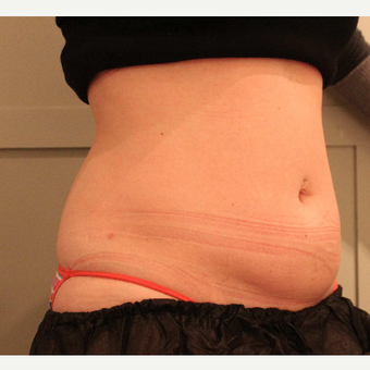 35-44 year old woman treated with CoolSculpting before 3098394
