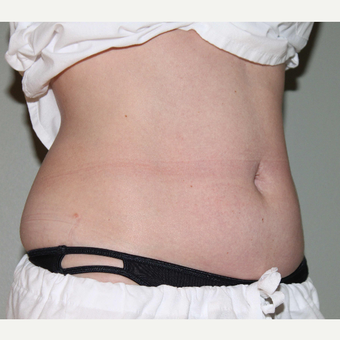 35-44 year old woman treated with CoolSculpting after 3098394