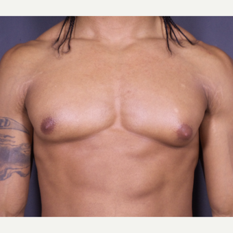 25-34 year old man treated with Male Breast Reduction before 3698231