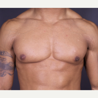 25-34 year old man treated with Male Breast Reduction after 3698231