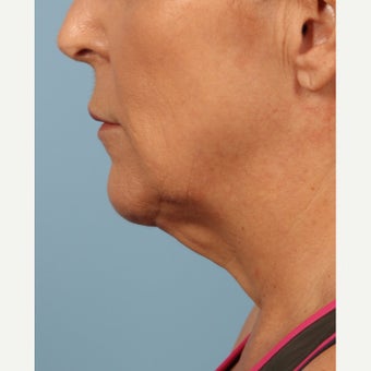 55-64 year old woman treated with Kybella after 2081062