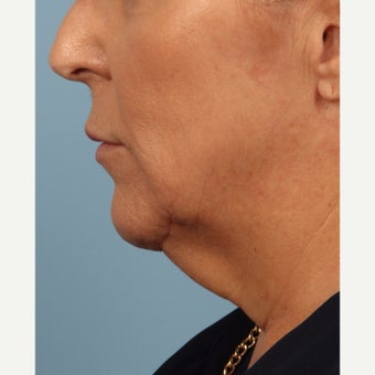 55-64 year old woman treated with Kybella before 2081062