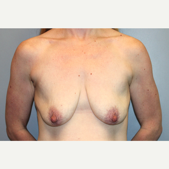 35-44 year old woman treated with Mommy Makeover before 3588691
