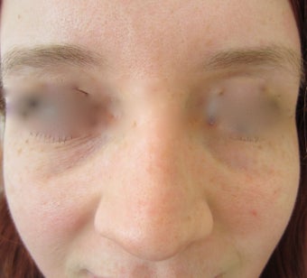 22 year-old female treated with Restylane filler for Tear Trough before 989346