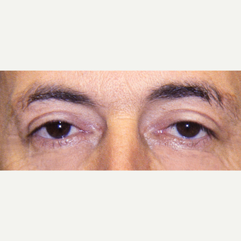 45-54 year old man treated with Eyelid Surgery after 3441118