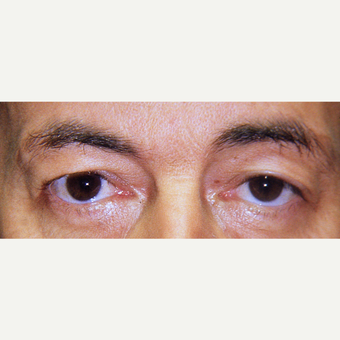 45-54 year old man treated with Eyelid Surgery before 3441118