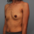 26 year old has breast augmentation 385cc Inspira Silicone Breast Implants before 3544191