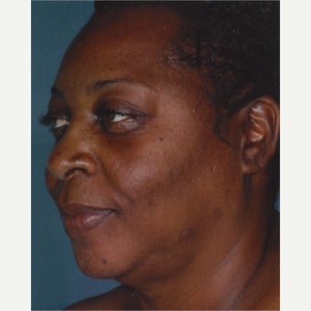 45-54 year old woman treated with Melasma Treatment with Obagi Nu Derm Skin Transformation System after 2581700