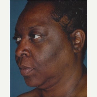 45-54 year old woman treated with Melasma Treatment with Obagi Nu Derm Skin Transformation System before 2581700