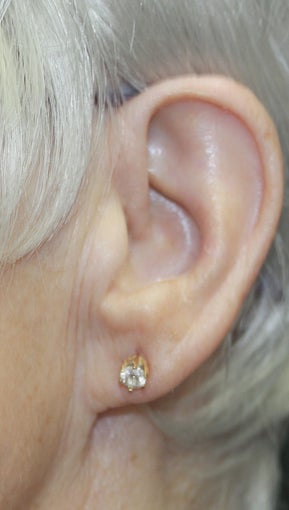 Procedure: Earlobe reduction after 1496661