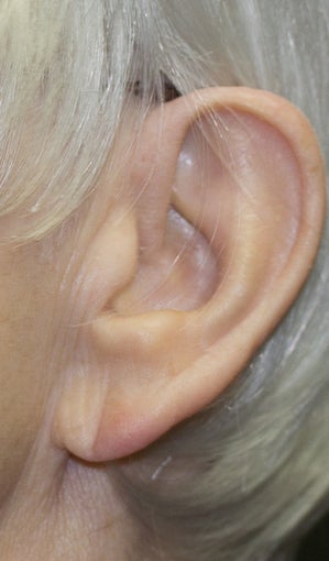 Procedure: Earlobe reduction before 1496661