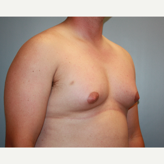 25-34 year old man treated with Male Breast Reduction before 3683186