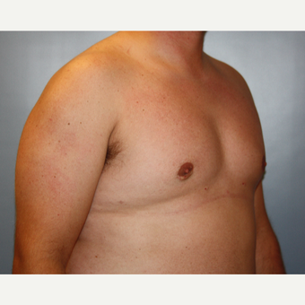 25-34 year old man treated with Male Breast Reduction after 3683186