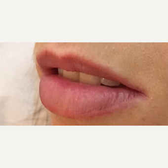 25-34 year old woman treated with Botox before 3364550
