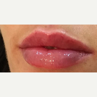 25-34 year old woman treated with Botox after 3364550