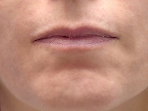 40 Year Old Female with Juvederm for Lips before 1139969