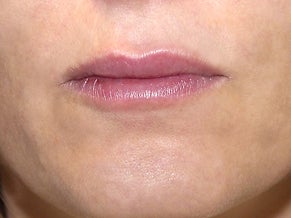 40 Year Old Female with Juvederm for Lips after 1139969