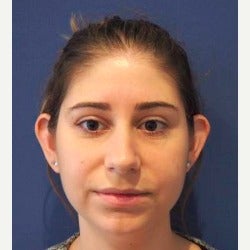 25-34 year old woman treated with Ear Surgery before 2563813