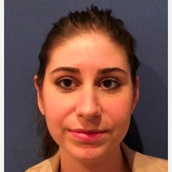 25-34 year old woman treated with Ear Surgery after 2563813