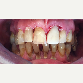 55-64 year old man - replacemenet of front tooth - following trauma after 3096967