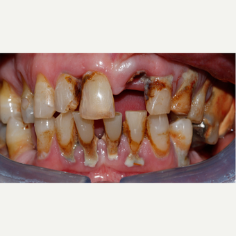 55-64 year old man - replacemenet of front tooth - following trauma before 3096967